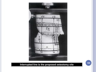 100
Interrupted line is the proposed osteotomy site
 