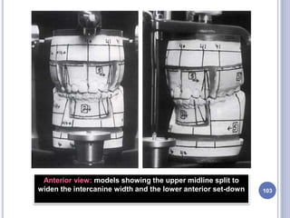 103
Anterior view: models showing the upper midline split to
widen the intercanine width and the lower anterior set-down
 