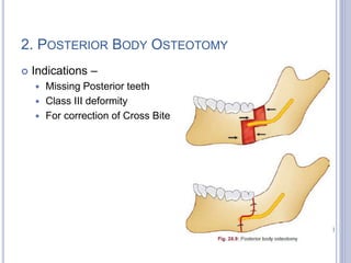 2. POSTERIOR BODY OSTEOTOMY
 Indications –
 Missing Posterior teeth
 Class III deformity
 For correction of Cross Bite
108
 