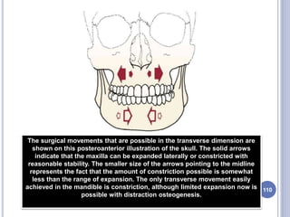 110
The surgical movements that are possible in the transverse dimension are
shown on this posteroanterior illustration of the skull. The solid arrows
indicate that the maxilla can be expanded laterally or constricted with
reasonable stability. The smaller size of the arrows pointing to the midline
represents the fact that the amount of constriction possible is somewhat
less than the range of expansion. The only transverse movement easily
achieved in the mandible is constriction, although limited expansion now is
possible with distraction osteogenesis.
 