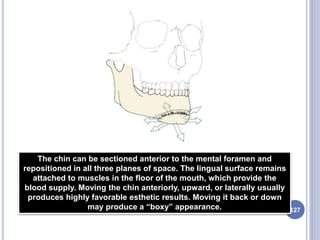 The chin can be sectioned anterior to the mental foramen and
repositioned in all three planes of space. The lingual surface remains
attached to muscles in the floor of the mouth, which provide the
blood supply. Moving the chin anteriorly, upward, or laterally usually
produces highly favorable esthetic results. Moving it back or down
may produce a “boxy” appearance. 127
 
