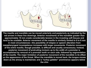 165
The maxilla and mandible can be moved anteriorly and posteriorly as indicated by the
red arrows in these line drawings. Anterior movements of the mandible greater than
approximately 10 mm create considerable tension in the investing soft tissues and
tend to be unstable. Anterior movement of the maxilla is similarly limited to 6 to 8 mm
in most circumstances—the possibility of relapse or speech alteration from
nasopharyngeal incompetence increases with larger movements. Posterior movement
of the entire maxilla, though possible, is difficult and usually unnecessary. Instead,
posterior movement of protruding incisors up to the width of a premolar is
accomplished by removal of a premolar tooth on each side, followed by segmentation
of the maxilla. The major limitation of posterior movement of the mandible is its effect
on the appearance of the throat. When the mandible is moved back, the tongue moves
down as the airway is maintained, and a “turkey gobbler” prominence appears below
the chin
 