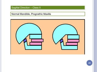 Sagittal Direction – Class II
Normal Mandible, Prognathic Maxilla
23
 