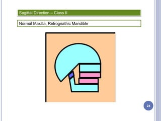 Normal Maxilla, Retrognathic Mandible
Sagittal Direction – Class II
24
 