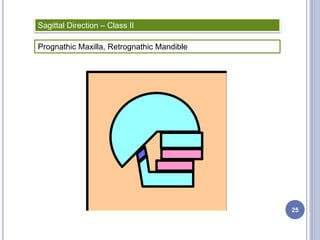 Sagittal Direction – Class II
Prognathic Maxilla, Retrognathic Mandible
25
 