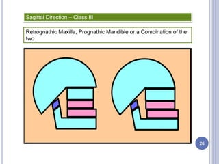 Sagittal Direction – Class III
Retrognathic Maxilla, Prognathic Mandible or a Combination of the
two
26
 