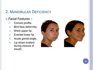 2. MANDIBULAR DEFICIENCY
 Facial Features –
1. Convex profile.
2. Bird face deformity.
3. Short upper lip.
4. Everted lower lip.
5. Acute gonial angle.
6. Lip strain evident
during closure of
mouth.
35
 
