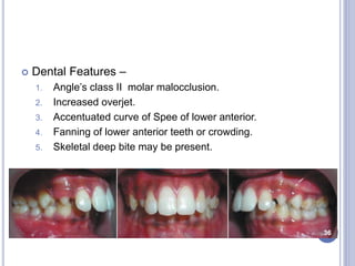  Dental Features –
1. Angle’s class II molar malocclusion.
2. Increased overjet.
3. Accentuated curve of Spee of lower anterior.
4. Fanning of lower anterior teeth or crowding.
5. Skeletal deep bite may be present.
36
 
