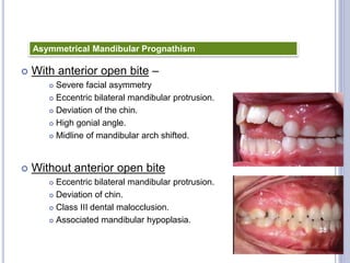  With anterior open bite –
 Severe facial asymmetry
 Eccentric bilateral mandibular protrusion.
 Deviation of the chin.
 High gonial angle.
 Midline of mandibular arch shifted.
 Without anterior open bite
 Eccentric bilateral mandibular protrusion.
 Deviation of chin.
 Class III dental malocclusion.
 Associated mandibular hypoplasia.
Asymmetrical Mandibular Prognathism
38
 