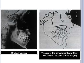 69
Original tracing Tracing of the structures that will not
be changed by mandibular surgery
 