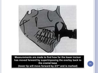 71
Measurements are made to find how far the lower incisor
has moved forward by superimposing the overlay back to
the cranial base
(lower lip will move forward by 2/3rd and is marked)
 