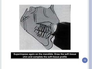 72
Superimpose again on the mandible. Draw the soft tissue
chin and complete the soft tissue profile
 