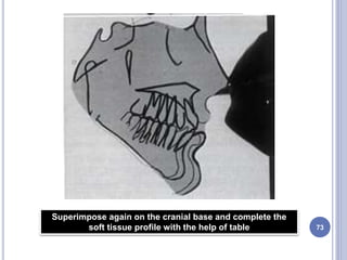 73
Superimpose again on the cranial base and complete the
soft tissue profile with the help of table
 