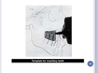 76
Template for maxillary teeth
 