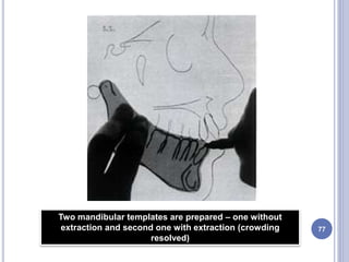 77
Two mandibular templates are prepared – one without
extraction and second one with extraction (crowding
resolved)
 