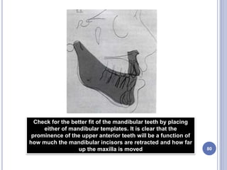 80
Check for the better fit of the mandibular teeth by placing
either of mandibular templates. It is clear that the
prominence of the upper anterior teeth will be a function of
how much the mandibular incisors are retracted and how far
up the maxilla is moved
 