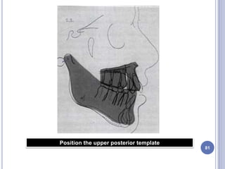 81
Position the upper posterior template
 