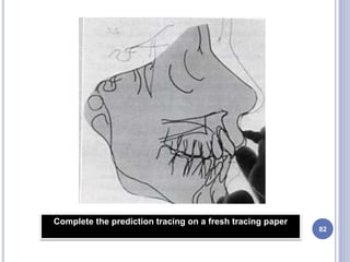 82
Complete the prediction tracing on a fresh tracing paper
 