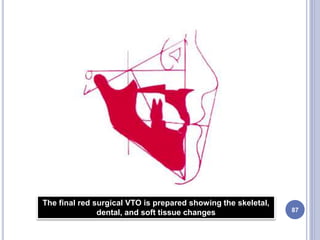 87
The final red surgical VTO is prepared showing the skeletal,
dental, and soft tissue changes
 