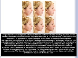 91
Surgical predictions for a patient with skeletal Class II problem, with mild maxillary retrusion, severe
mandibular retrotrusion and inadequate projection of the chin. A, The initial tracing linked to the profile
photograph. B, Simulation of 5 mm mandibular advancement, an amount of advancement
corresponding to the initial overjet. C, 5 mm mandibular advancement plus genioplasty to improve chin
projection relative to the lower incisor. D, 6 mm maxilla advancement, 11 mm mandibular advancement,
and rhinoplasty. The maxilla was advanced to increase support of upper lip and allow for greater
mandibular advancement. E, Presurgical retraction of the lower incisors after lower premolar
extraction, creating more overjet and allowing a 9 mm mandibular advancement. F, Retraction of lower
incisors, 9 mm advancement, and rhinoplasty. The rhinoplasty changes were subtle, and it was not
recommended. After the patient and her parents viewed the simulations and discussed it with the
orthodontist, E was selected as the plan.
 