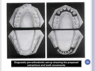 94Diagnostic pre-orthodontic set-up showing the proposed
extractions and tooth movements
 