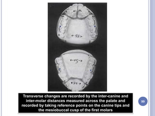99
Transverse changes are recorded by the inter-canine and
inter-molar distances measured across the palate and
recorded by taking reference points on the canine tips and
the mesiobuccal cusp of the first molars
 