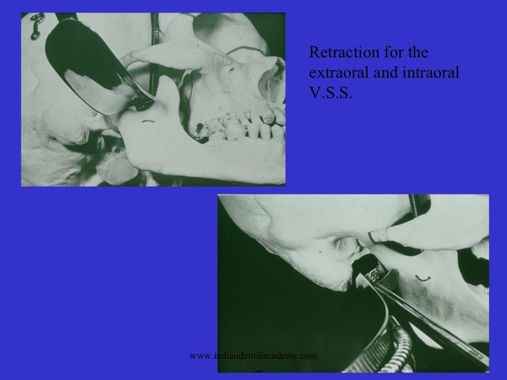 Mandibular osteotomies / oral surgery courses