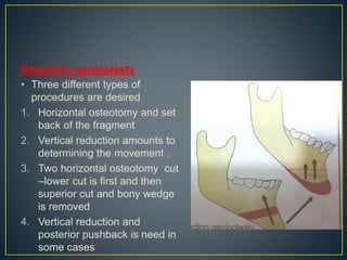 Reduction genioplasty
• Three different types of
procedures are desired
1. Horizontal osteotomy and set
back of the fragment
2. Vertical reduction amounts to
determining the movement .
3. Two horizontal osteotomy cut
–lower cut is first and then
superior cut and bony wedge
is removed
4. Vertical reduction and
posterior pushback is need in
some cases
 