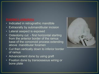 Inverted L osteotomy
• Indicated in retrognathic mandible
• Extraorally by submandibular incision
• Lateral asepect is exposed
• Osteotomy cut - first horizontal starting
from the anterior border of the ramus
base of the coroonoid process extending
above mandibular foramen
• Cut then vertically down to inferior border
of ramus
• Advancement done by using graft
• Fixation done by transosseous wiring or
bone plate
 
