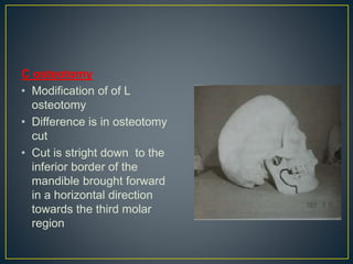 C osteotomy
• Modification of of L
osteotomy
• Difference is in osteotomy
cut
• Cut is stright down to the
inferior border of the
mandible brought forward
in a horizontal direction
towards the third molar
region
 