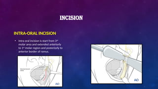 INCISION
INTRA-ORAL INCISION
• Intra oral incision is start from 3rd
molar area and extended anteriorly
to 1st
molar region and posteriorly to
anterior border of ramus.
 