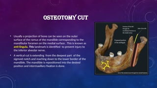 OSTEOTOMY CUT
• Usually a projection of bone can be seen on the outer
surface of the ramus of the mandible corresponding to the
mandibular foramen on the medial surface . This is known as
anti-lingula. This landmark is identified to prevent injury to
the inferior alveolar nerve.
• A vertical cut is extending from the deepest part of the
sigmoid notch and reaching down to the lower border of the
mandible. The mandible is repositioned into the desired
position and intermaxillary fixation is done.
 