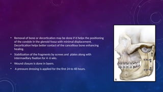 • Removal of bone or decortication may be done if it helps the positioning
of the condyle in the glenoid fossa with minimal displacement.
Decortication helps better contact of the cancellous bone enhancing
healing.
• Stabilization of the fragments by screws and plates along with
intermaxillary fixation for 4- 6 wks.
• Wound closure is done in layers.
• A pressure dressing is applied for the first 24 to 48 hours.
 