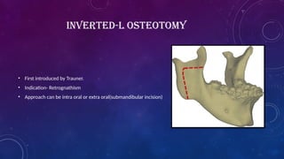 INVERTED-L OSTEOTOMY
• First introduced by Trauner.
• Indication- Retrognathism
• Approach can be intra oral or extra oral(submandibular incision)
 