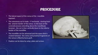 PROCEDURE
• The lateral aspect of the ramus of the mandible
exposed .
• The osteotomy cut is made 1st
horizontal , starting from
the anterior border of the ramus to the base of the
coronoid process extending above the mandibular
foramen , the cut is then vertically down to the inferior
border of the mandible.
• The mandible can be advanced and the space that is
created between the ramus and proximal fragments of
the ramus is filled by bone graft .
• Fixation can be done by using plate and screws.
 
