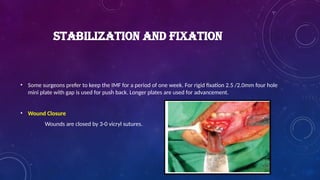 STABILIZATION AND FIXATION
• Some surgeons prefer to keep the IMF for a period of one week. For rigid fixation 2.5 /2.0mm four hole
mini plate with gap is used for push back. Longer plates are used for advancement.
• Wound Closure
Wounds are closed by 3-0 vicryl sutures.
 