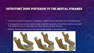OSTEOTOMY DONE POSTERIOR TO THE MENTAL FORAMEN
• The tooth in the line of osteotomy is extracted., vertical cuts are made till the line of mental foramen.
• A rectangular buccal cortical window is made to identify the position of the inferior alveolar nerve with
in the bone.The cuts are made below the nerve and piece of bone removed.
• Similarly ,the bone present above the neuro vascular bundle is removed carefully
 