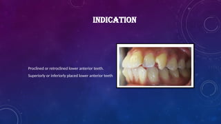 INDICATION
Proclined or retroclined lower anterior teeth.
Superiorly or inferiorly placed lower anterior teeth
 