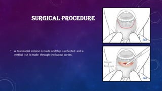 SURGICAL PROCEDURE
• A translabial incision is made and flap is reflected and a
vertical cut is made through the buccal cortex.
 