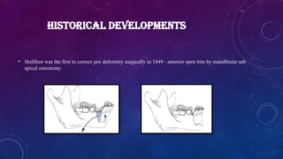 HISTORICAL DEVELOPMENTS
• Hullihen was the first to correct jaw deformity surgically in 1849 - anterior open bite by mandibular sub
apical osteotomy.
 