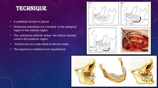 TECHNIQUE
• A vestibular incision is placed
• Horizontal osteotomy cut is located in the subapical
region in the anterior region
• The osteotomy extends below the inferior alveolar
canal in the posterior region
• Vertical cuts are made distal to the last molar.
• The segment is mobilized and repositioned.
 
