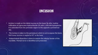 • Incision is made on the labial mucosa on the lower lip after routine
infiltration of Lignocaine Hydrochloride 2% with 1:200,000 Epinephrine.
It is extended from the premolar region to the opposite symmetrical
site.
• The incision is taken to the periosteum which is cut to expose the bone.
Soft tissue incision is angled at 45˚ to the bone
• Subperiosteal dissection is done to expose the inferior border of the
mandible. Mental nerve is identified and protected.
INCISION
 