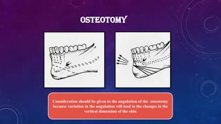 OSTEOTOMY
Consideration should be given to the angulation of the osteotomy
because variation in the angulation will lead to the changes in the
vertical dimension of the chin
 