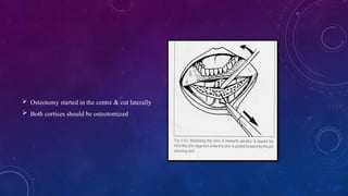  Osteotomy started in the centre & cut laterally
 Both cortices should be osteotomized
 