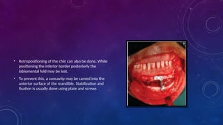 • Retropositioning of the chin can also be done, While
positioning the inferior border posteriorly the
labiomental fold may be lost.
• To prevent this, a concavity may be carved into the
anterior surface of the mandible. Stabilization and
fixation is usually done using plate and screws
 