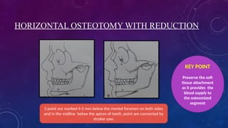 HORIZONTAL OSTEOTOMY WITH REDUCTION
3 point are marked 4-5 mm below the mental foramen on both sides
and in the midline below the apices of teeth, point are connected by
stryker saw.
KEY POINT
Preserve the soft
tissue attachment
as it provides the
blood supply to
the osteomized
segment
 