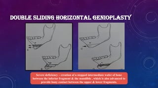 DOUBLE SLIDING HORIZONTAL GENIOPLASTY
Severe deficiency – creation of a stepped intermediate wafer of bone
between the inferior fragment & the mandible , which is also advanced to
provide bony contact between the upper & lower fragments.
 