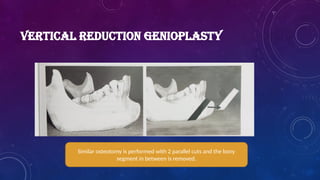 VERTICAL REDUCTION GENIOPLASTY
Similar osteotomy is performed with 2 parallel cuts and the bony
segment in between is removed.
 