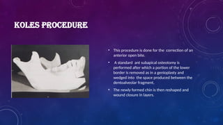 KOLES PROCEDURE
• This procedure is done for the correction of an
anterior open bite.
• A standard ant subapical osteotomy is
performed after which a portion of the lower
border is removed as in a genioplasty and
wedged into the space produced between the
dentoalveolar fragment.
• The newly formed chin is then reshaped and
wound closure in layers.
 