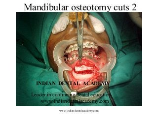 Mandibular osteotomy cuts 2
INDIAN DENTAL ACADEMY
Leader in continuing dental education
www.indiandentalacademy.com
www.indiandentalacademy.com
 
